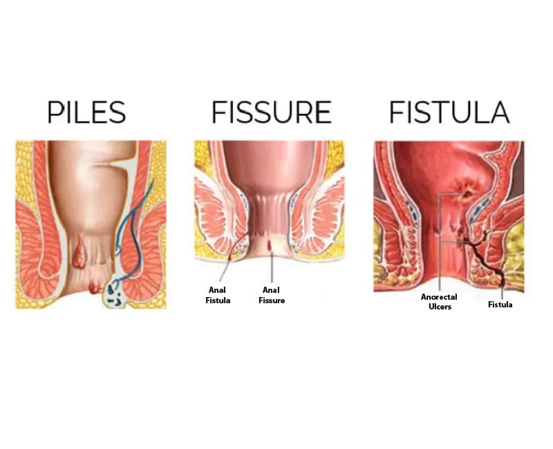 Fissure Surgery